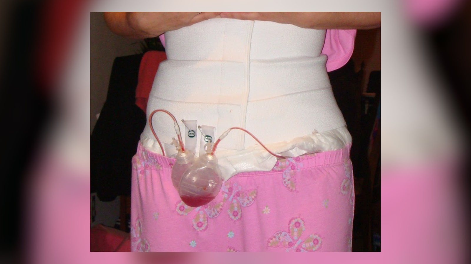 Traditional tummy tuck recovery with post-surgical drains