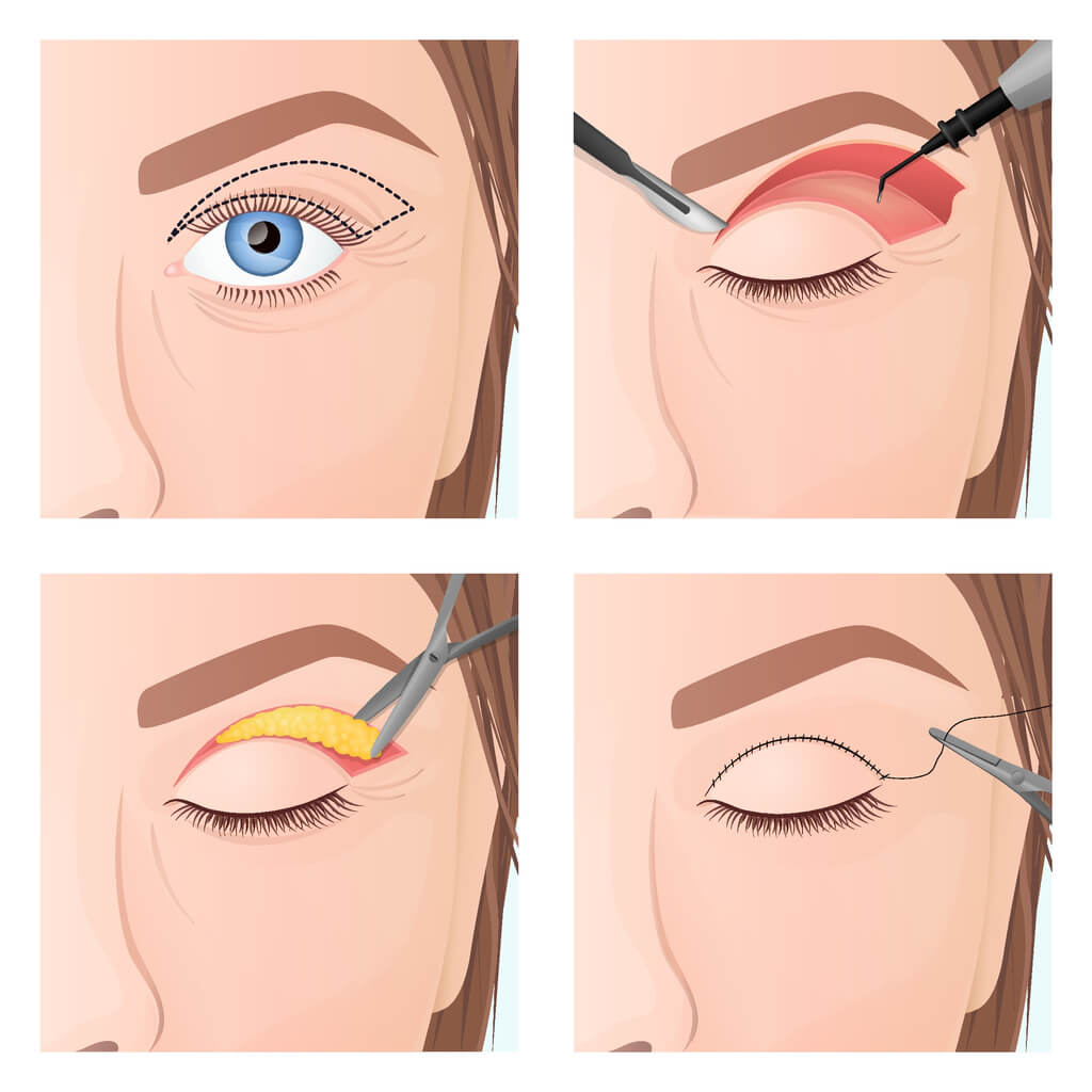 Oberlidstraffung und Haut Resektion am Oberlid- Schnitt und Narbe eines Blepharoplastik- Berlin Augenlidkorrektur durch ästhetisch plastische Chirurgie