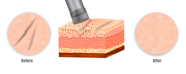 Narbenbehandlung mit Microneedling