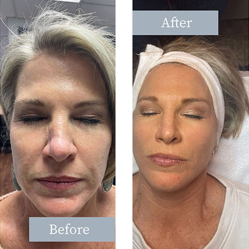 Before and after showing Microneedling results in face
