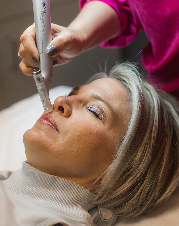 Micro needling demonstration