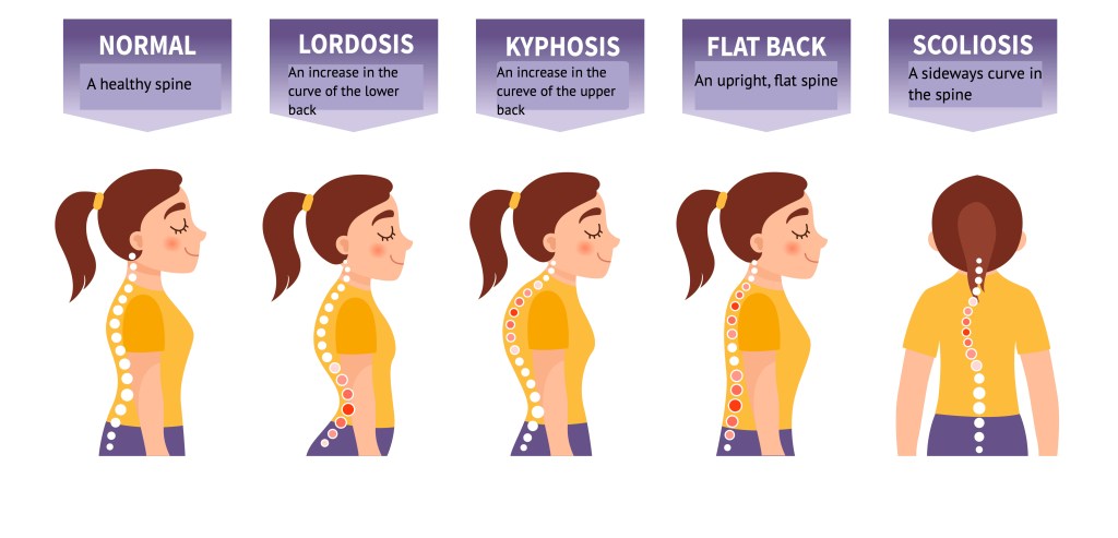 Why Does A Dowager s Hump Develop And How You Can Treat It 