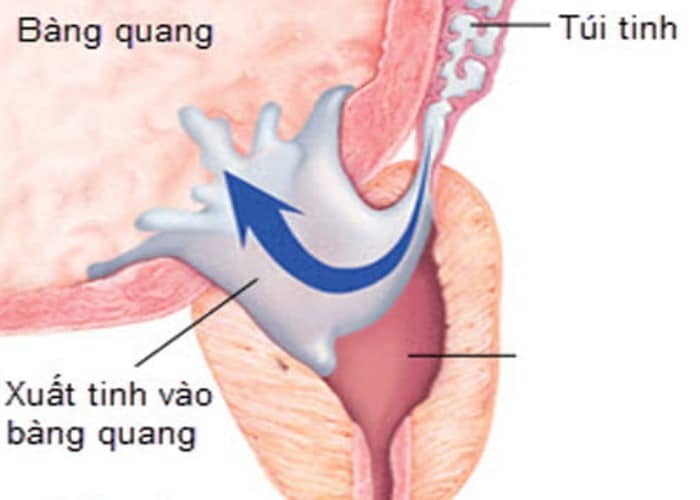 Xuất tinh ngược dòng có thể gây ra tình trạng tiểu đục như nước vo gạo
