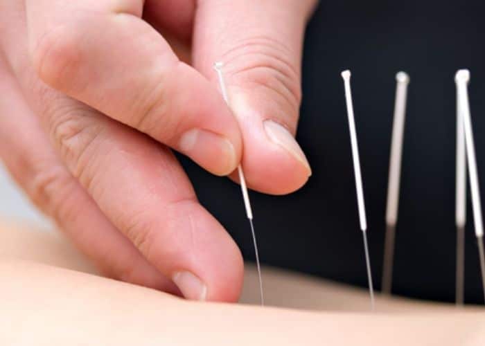 Châm cứu điều trị tiểu không tự chủ hiệu quả