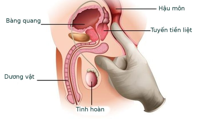 Đái dầm khi say cũng có thể là dấu hiệu của việc giữ nước tiểu do phì đại tuyến tiền liệt