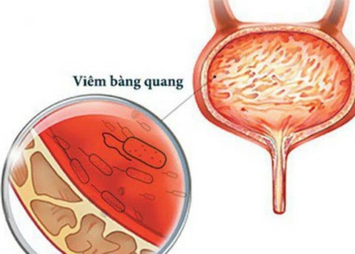 Viêm bàng quang gây tiểu buốt ra máu