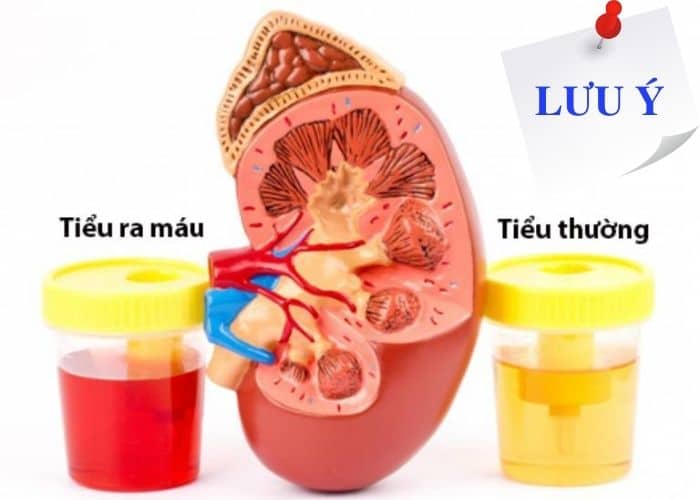 lưu ý cách chữa tiểu buốt ra máu tại nhà