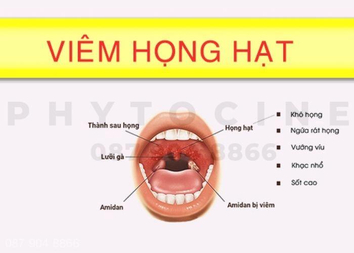 Viêm họng hạt thường kéo dài bao lâu?