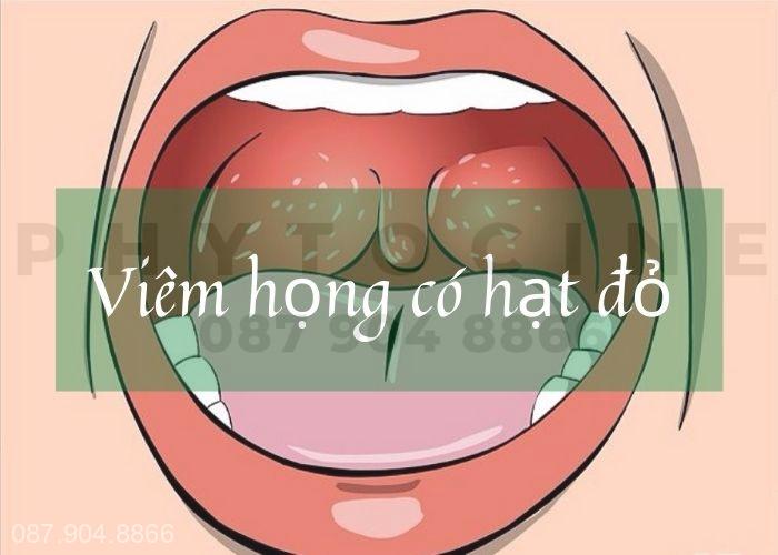 Viêm họng có hạt đỏ cảnh báo khá nhiều bệnh lý nguy hiểm, ảnh hưởng nghiêm trọng đến sức khỏe và chất lượng cuộc sống hàng ngày.