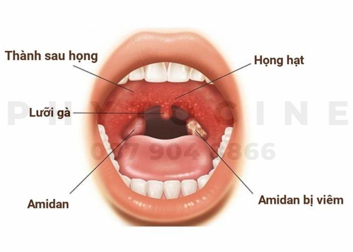 Hình ảnh viêm họng hạt. Viêm họng hạt có nguy hiểm không?