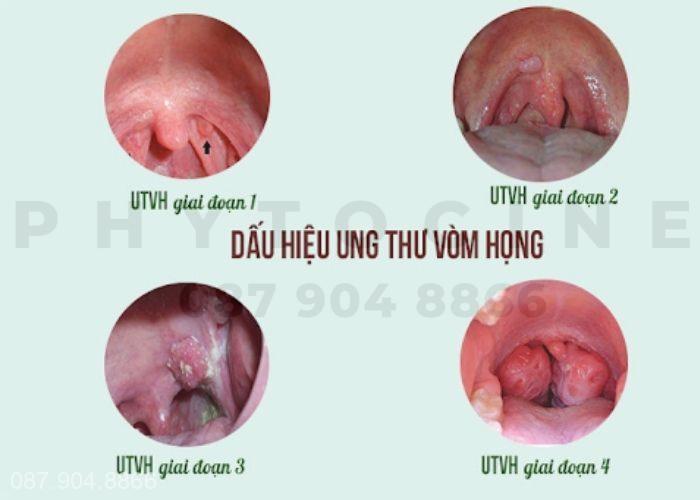 Hình ảnh ung thư vòm họng - Biến chứng đáng sợ của viêm họng hạt đỏ