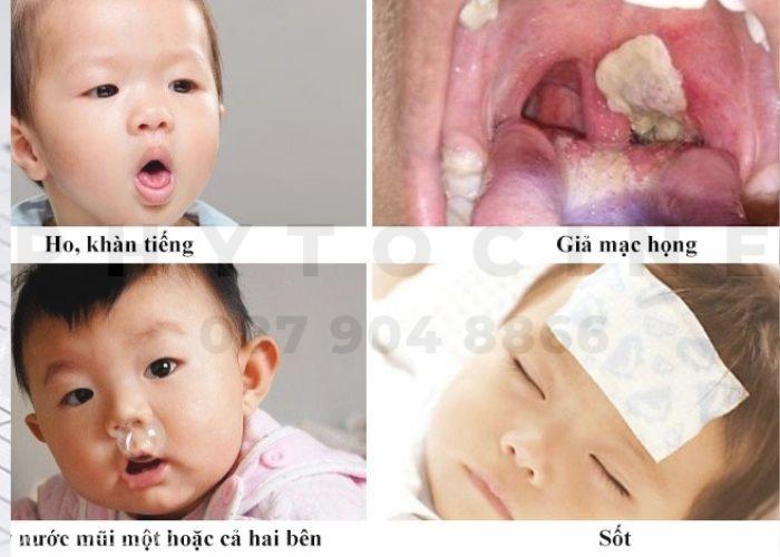 Triệu chứng viêm họng giả mạc