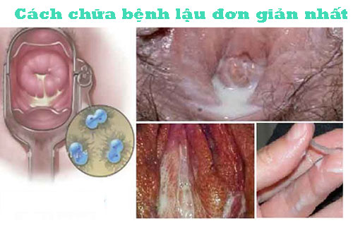 Cách chữa bệnh lậu đơn giản nhất