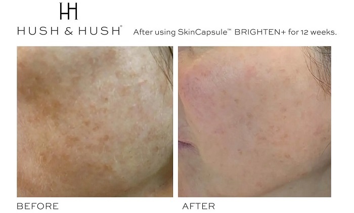 Kết quả sau 12 tuần sử dụng viên uống Hush & Hush Skincapsule Brighten+