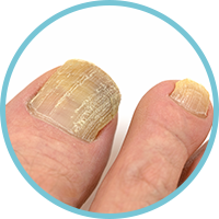 Thick Toenails