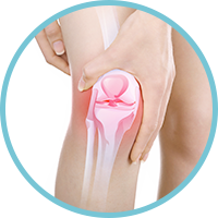 Posterior Cruciate Ligament Injury (PCL)