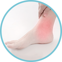 Posterior Tibial Tendon Dysfunction
