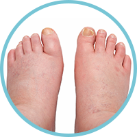 Peripheral Neuropathy