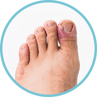 Ingrown Toenails