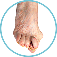 Hammer Toes