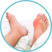 Gout