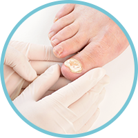 Fungal Nail Infection