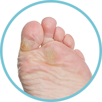 Callus