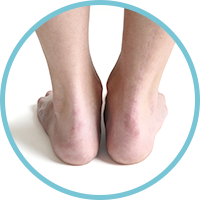 Achilles Tendonitis