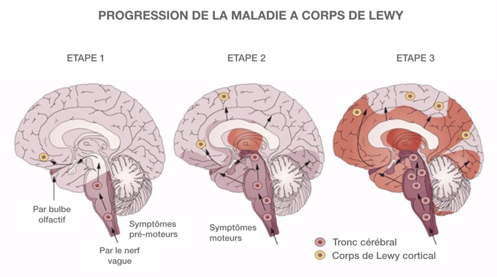 Alenvi Accompagner La Maladie Corps De Lewy