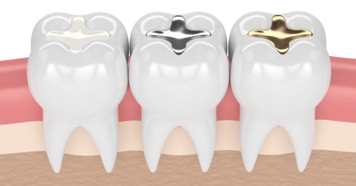 Dental Filling | Tooth Filling | Cavity Filling