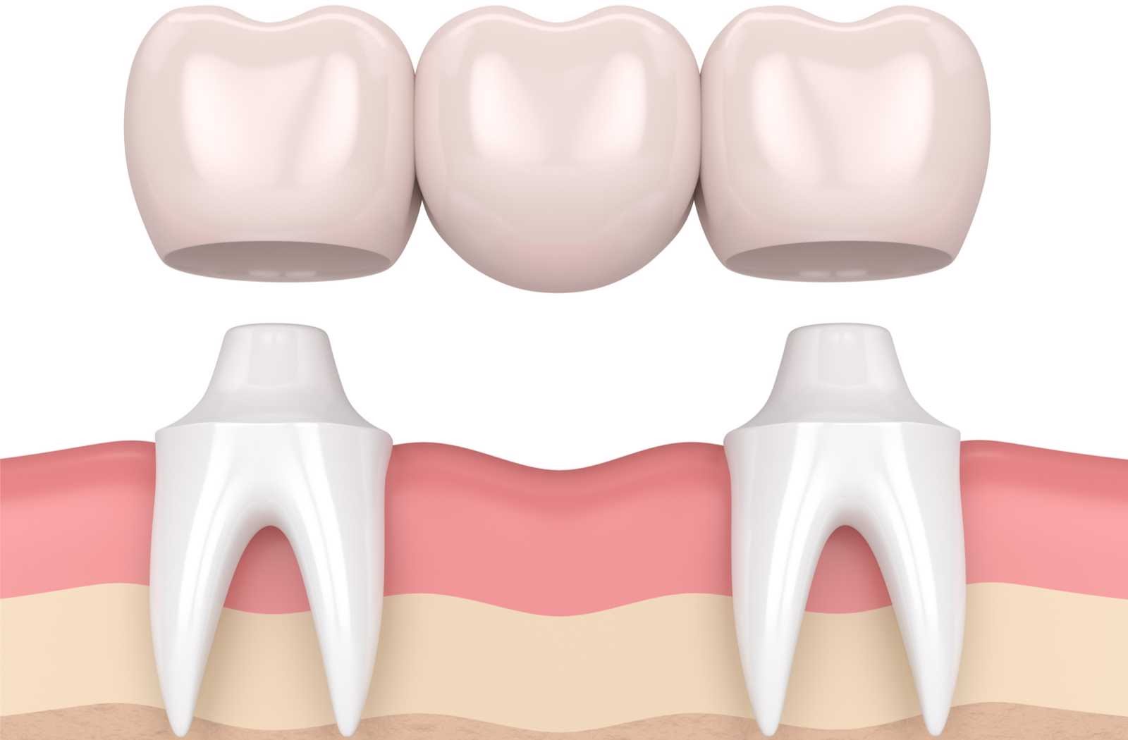 What is a Dental Bridge?
