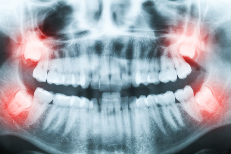 Types of Wisdom Teeth Removal - South Gables Dental