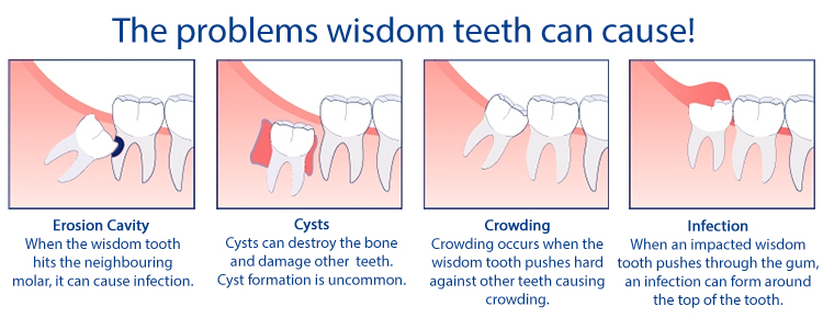 Wisdom Teeth Removal : Benefits of Having Tooth Extraction