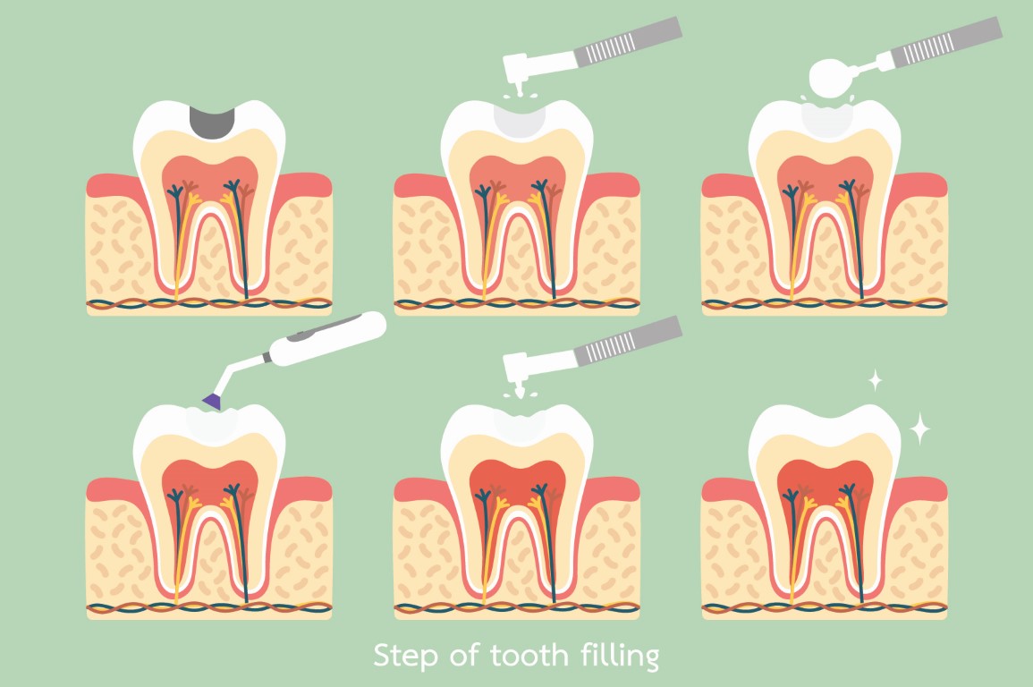Fillings - Papatoetoe Family Business