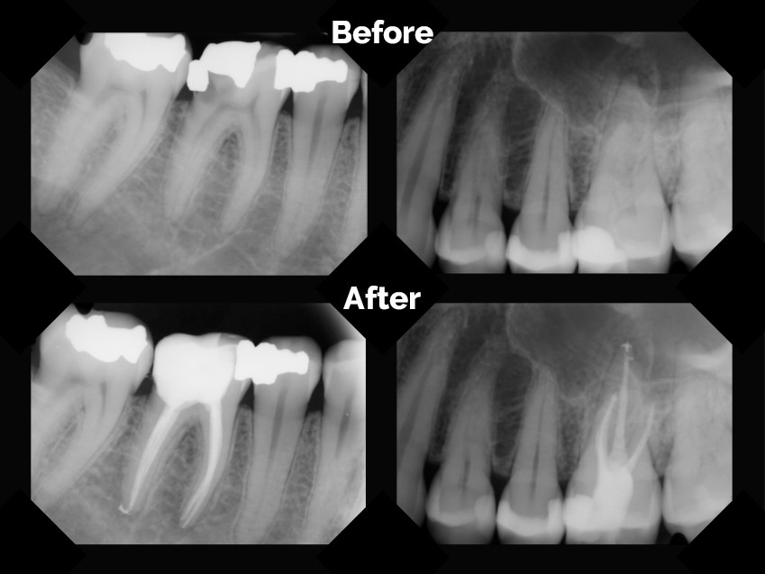 Thinking a Root Canal is the Death of Your Tooth? Think Again! - Ivoir Smiles