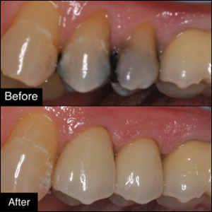 Dental Crowns and Bridges - Dr. Anderson