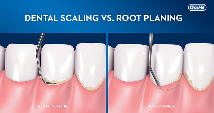 Dental Scaling and Root Planing Explained - Oral-B