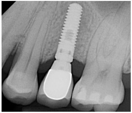 Tooth replacement options: Single tooth dental implant | Fridley, MN