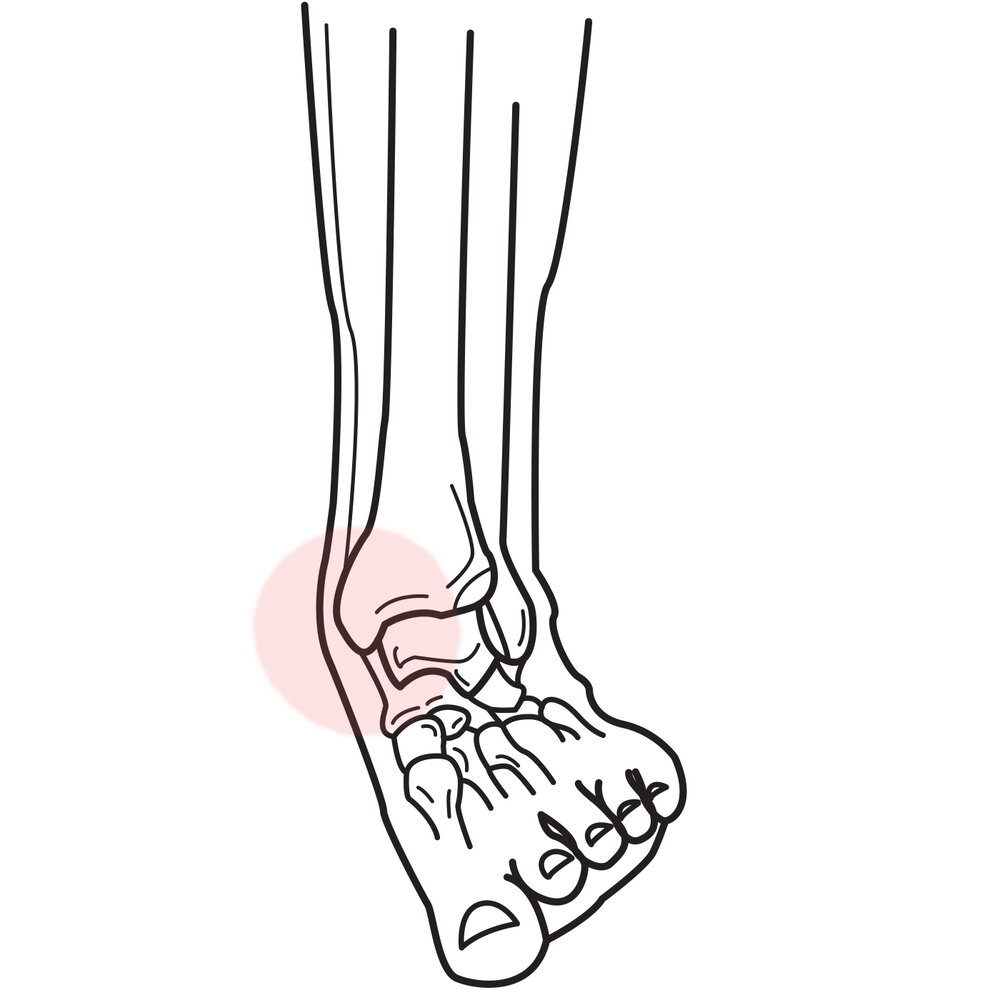 High Ankle Sprain