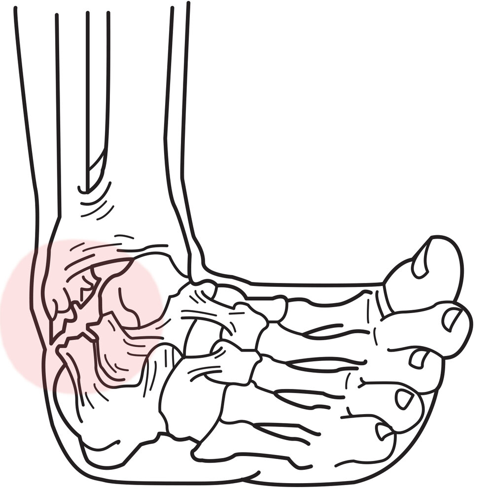 Common Ankle Sprain
