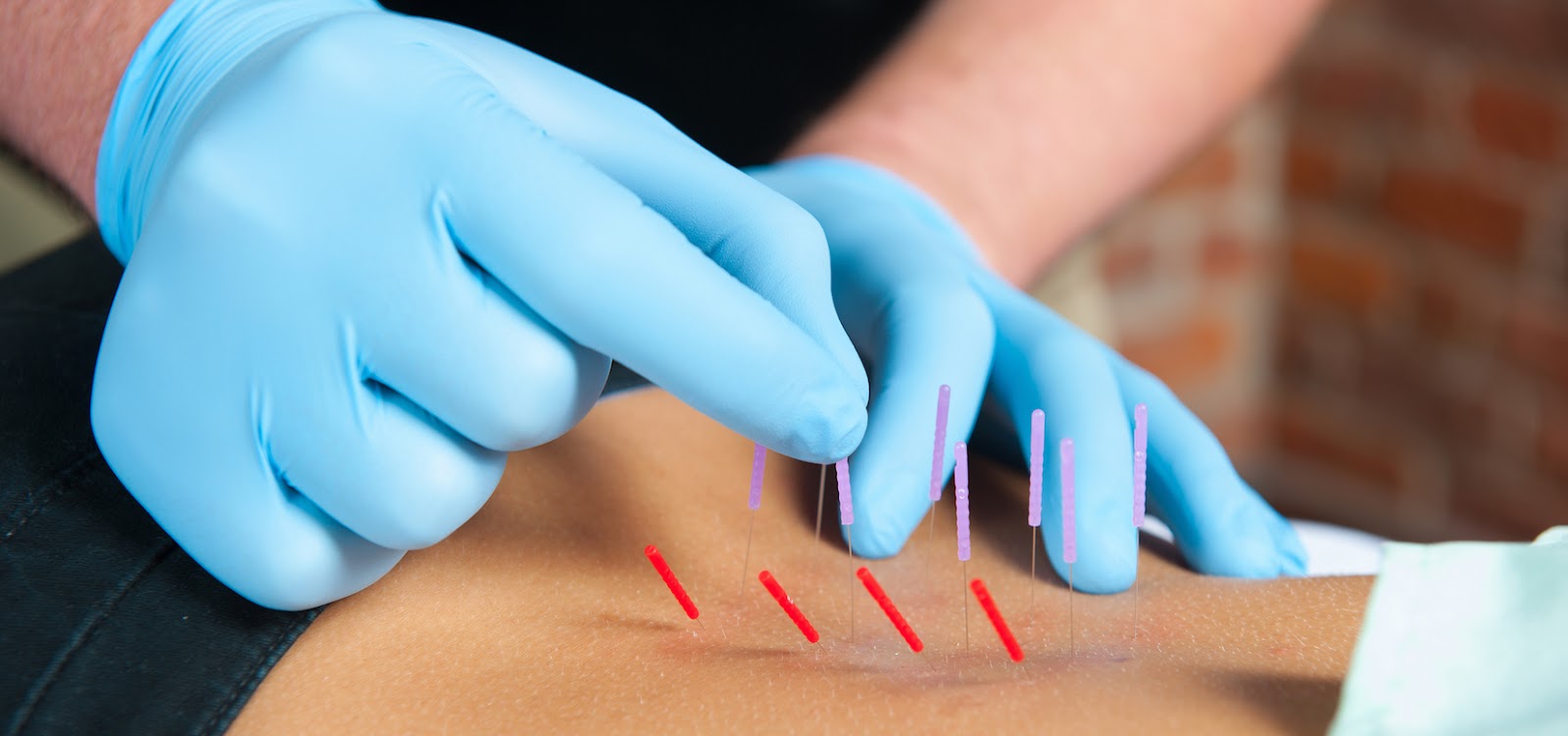What is dry needling and does it work?