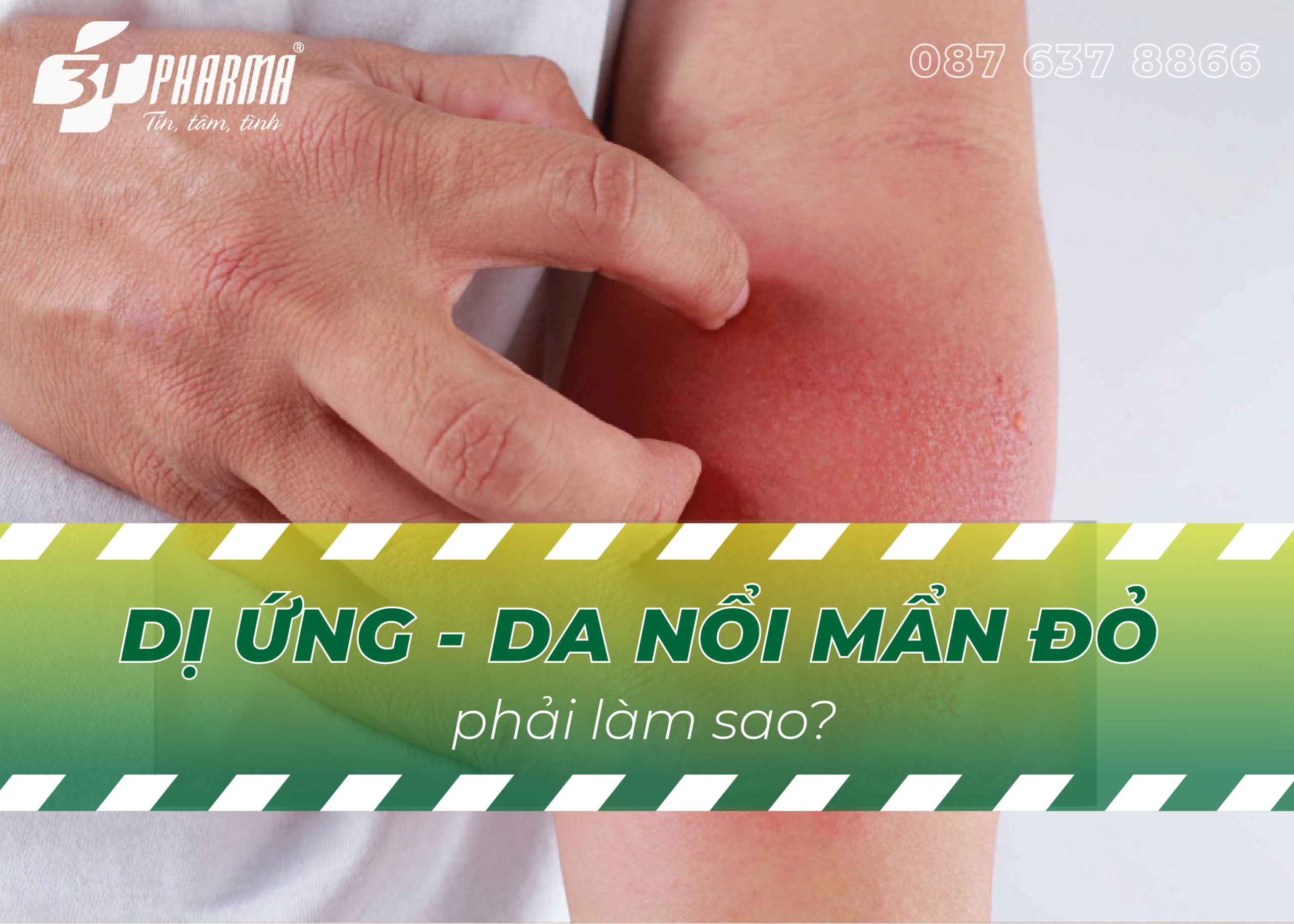 bị dị ứng da nổi mẩn đỏ
