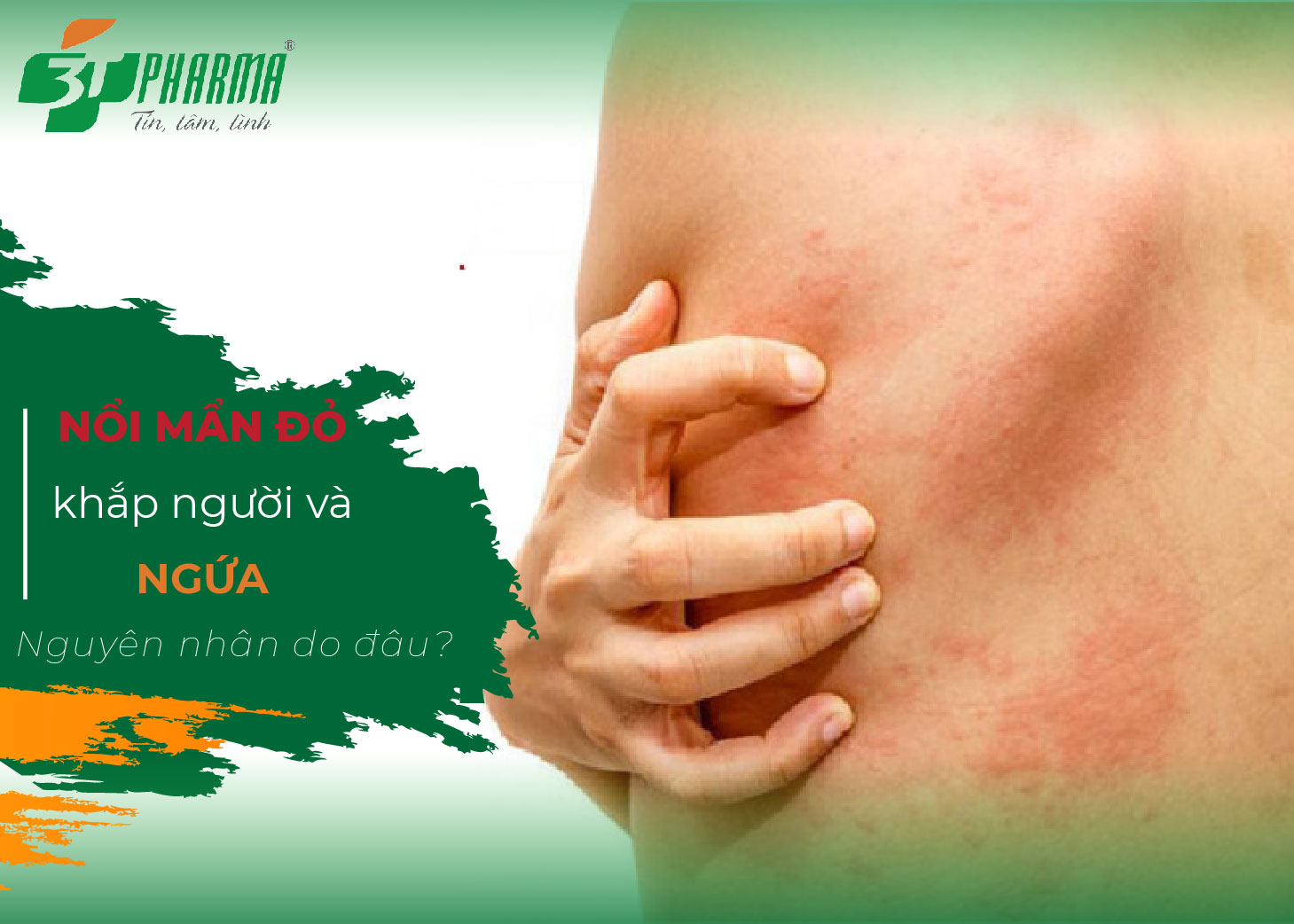 bị nổi mụn khắp người, bị nổi nốt ngứa khắp người, mẩn đỏ ngứa khắp người, ngứa khắp người, ngứa khắp người không nổi mẩn, ngứa khắp người nhưng không nổi mẩn, ngứa khắp người nổi mẩn đỏ, người nổi mụn nhỏ ngứa, nguyên nhân bị ngứa khắp người, nguyên nhân nổi mụn khắp người, nổi chấm đỏ khắp người không ngứa, nổi chấm đỏ ngứa khắp người, nổi hạt khắp người, nổi hạt ngứa khắp người, nổi hột đỏ ngứa khắp người, nổi hột ngứa khắp người, nổi mẩn đỏ khắp người không ngứa, nổi mụn khắp người, nổi mụn ngứa ở khắp người, nổi mụn ngứa ở người