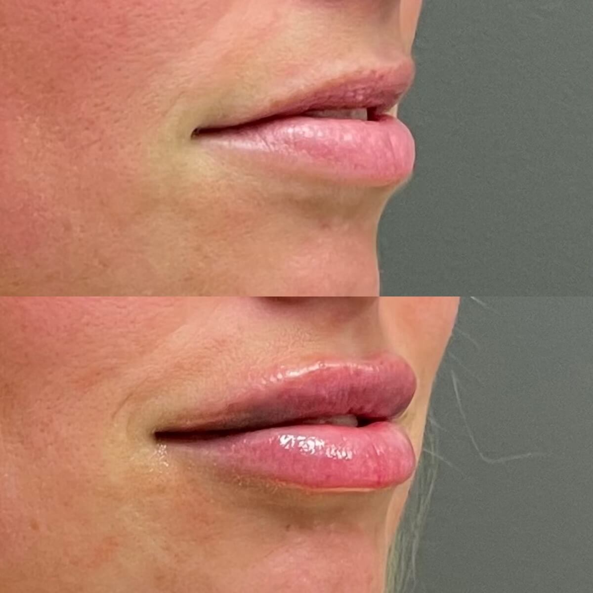 San Diego's Best Juvederm Filler Deals from iThriveBeauty