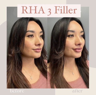 Juvederm Filler vs Botox: The 7 Main Differences You Need to Know ...