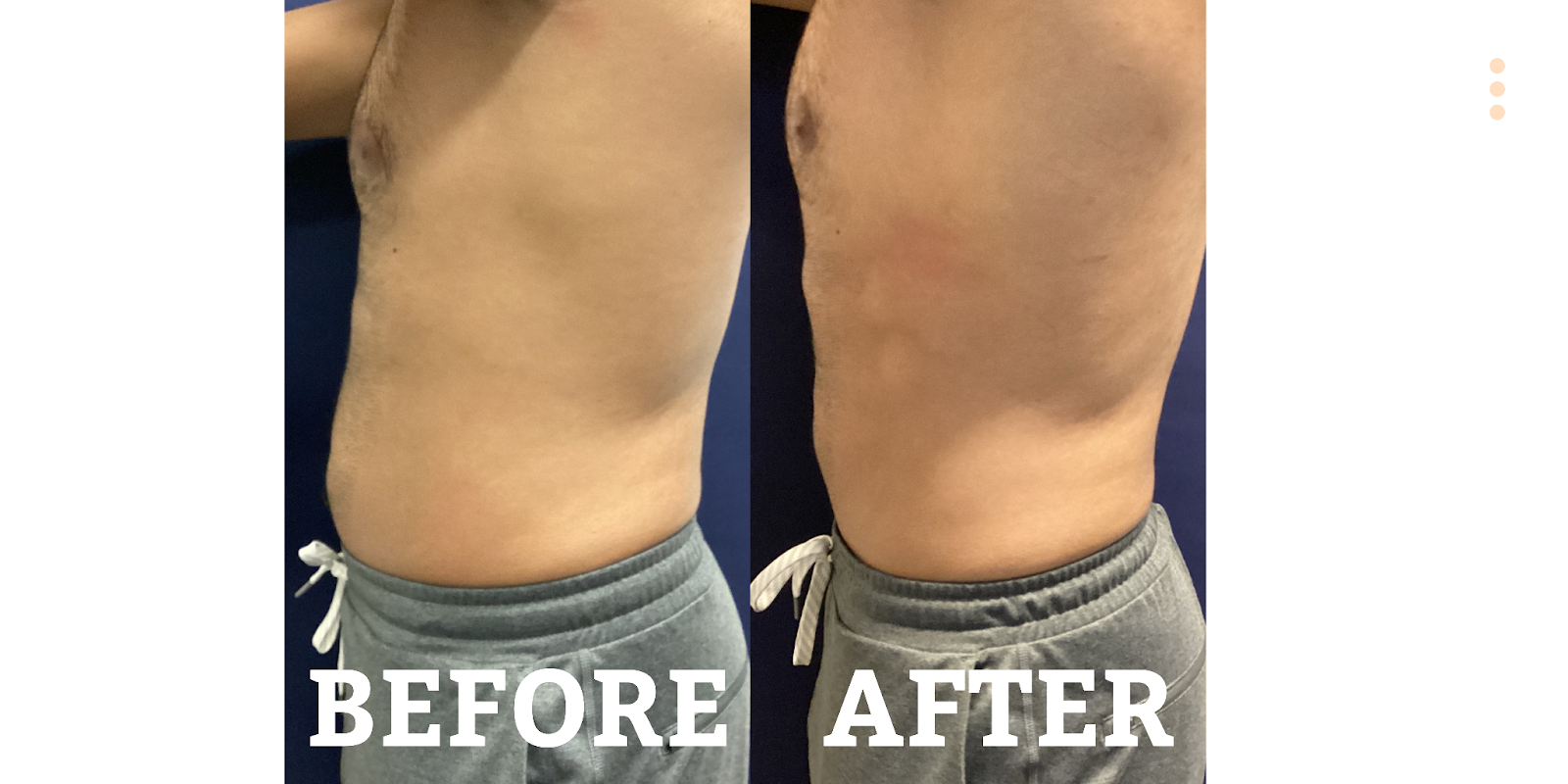 coolsculpting-and-semaglutide-the-weight-loss-combo-you-ve-been