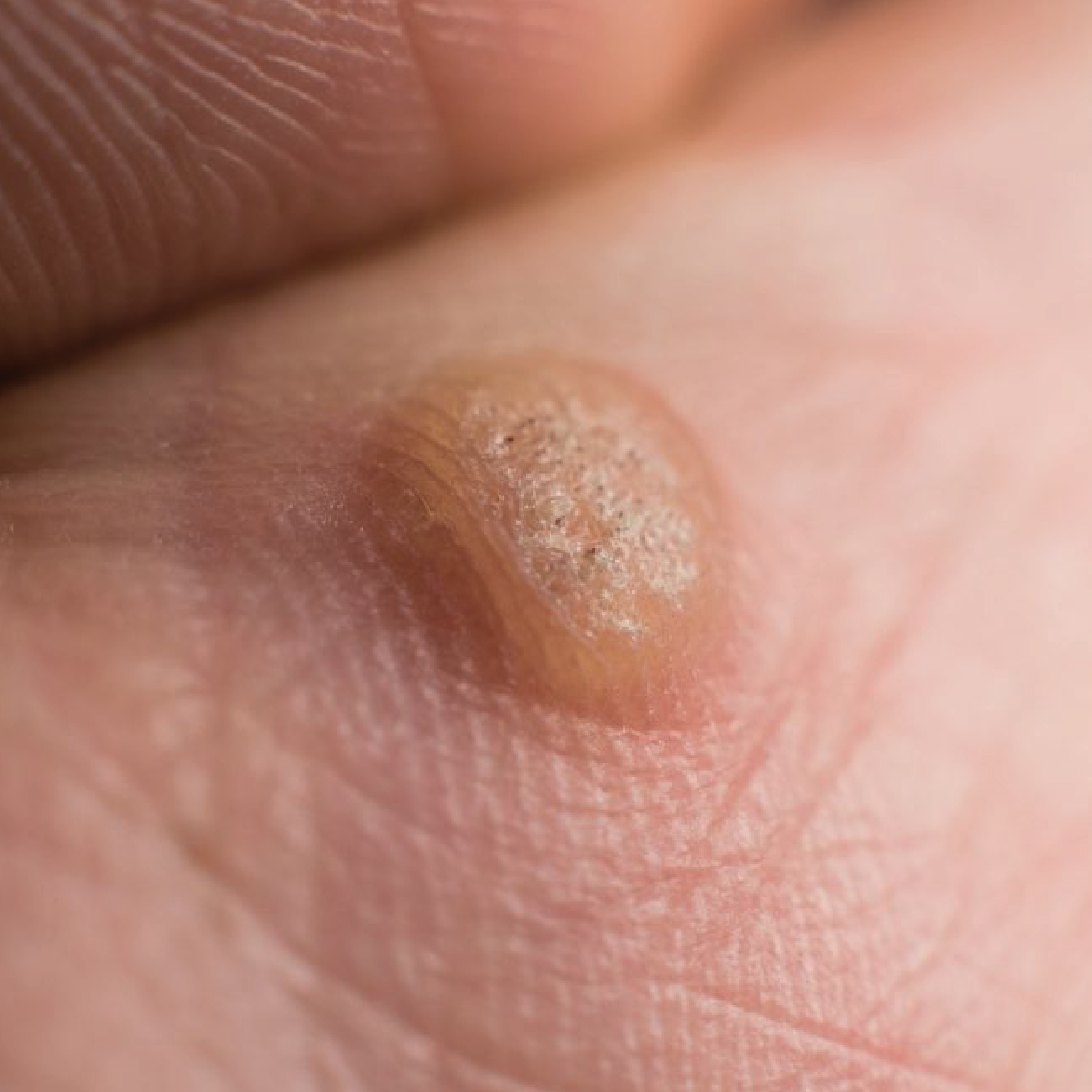 How to treat Skin Warts?