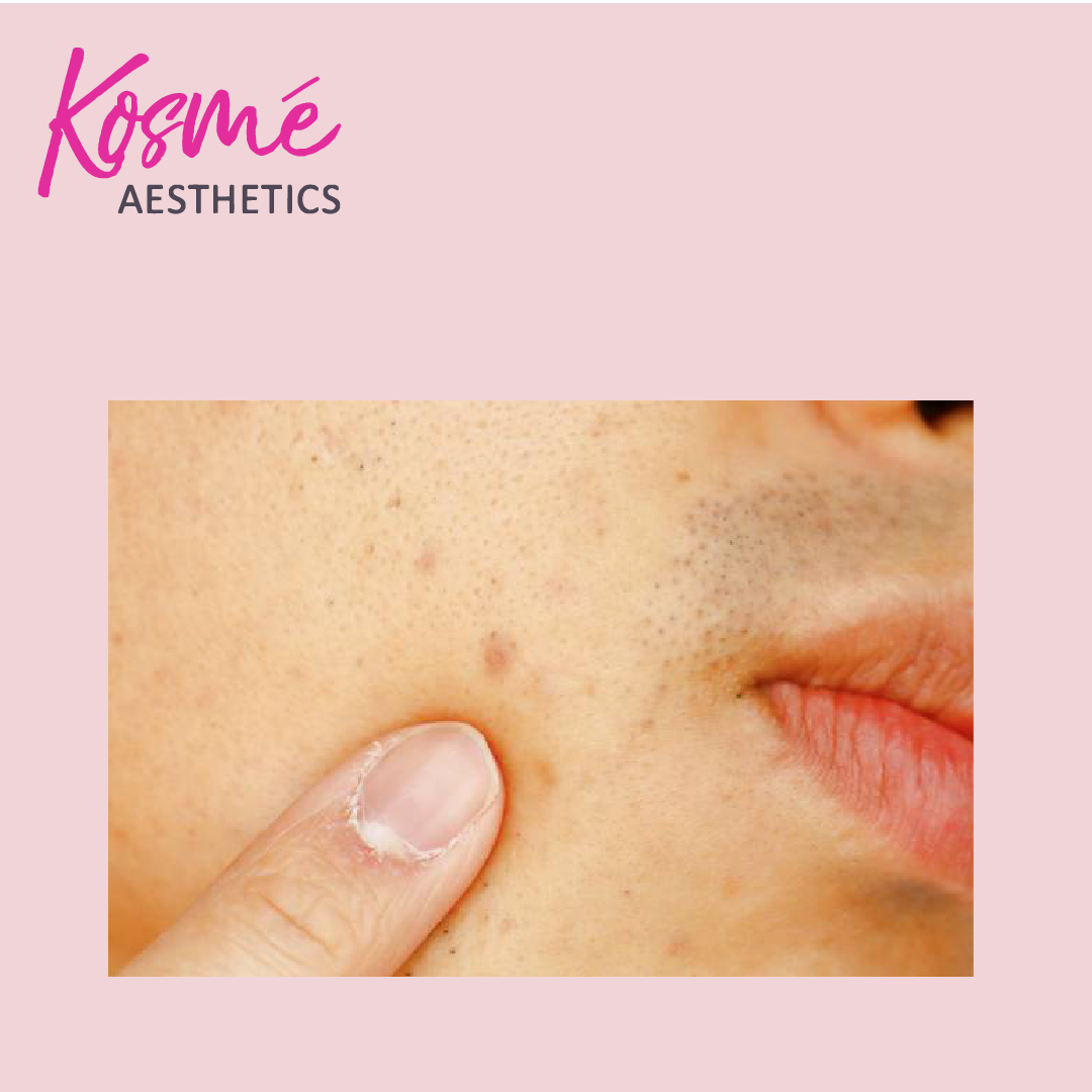 skin whitening treatments, age spots, lighter skin tone
