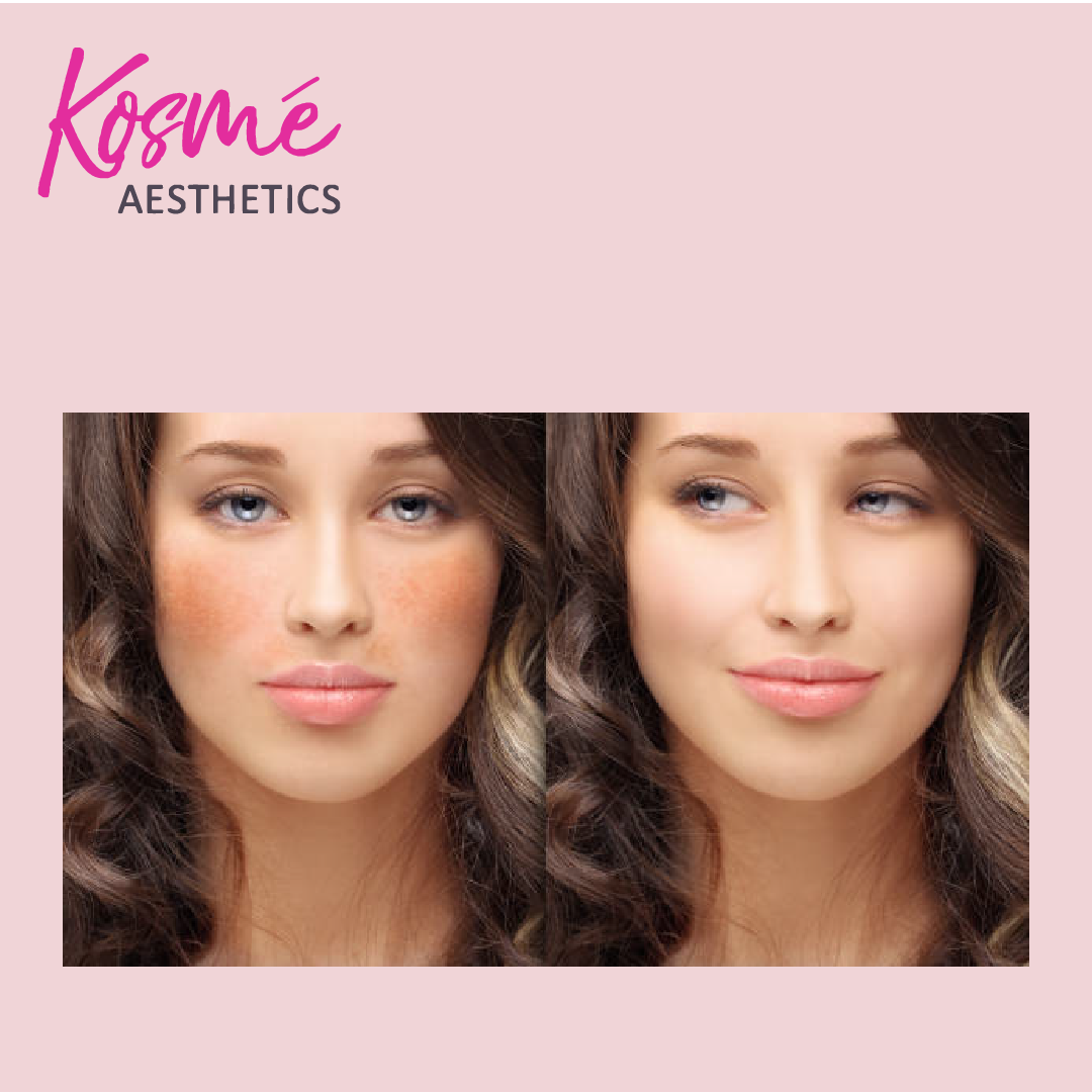 skin lightening and age spots(facial treatment) dull skin