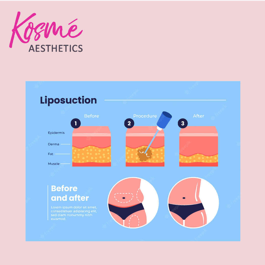 Liposuction method to lose weight (weight loss treatment) Slimming treatment singapore